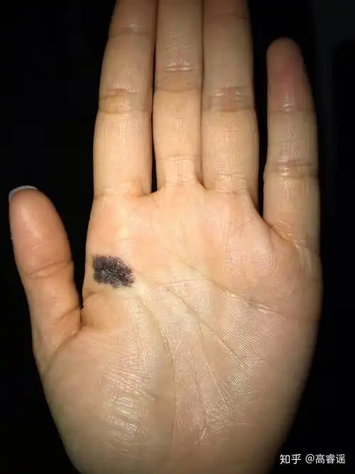 左手手掌侧边有痣(左手手掌边缘长了颗痣)