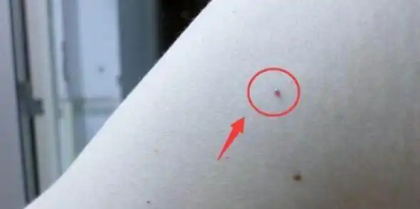 红痣与与血痣的区别