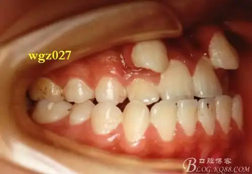 上颌尖牙越位患者的x线摄片原创