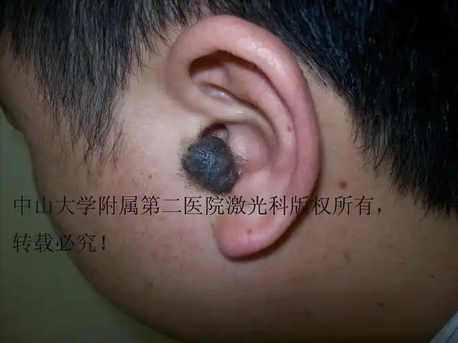 我用激光做的耳屏黑毛痣,手艺还不错吧! - 好大夫在线