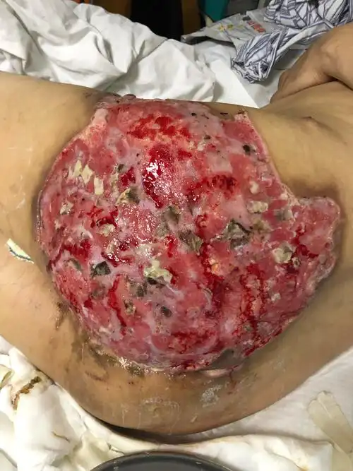 山西省人民医院肛肠科 原位皮肤邮票植皮术治疗化脓性汗腺炎