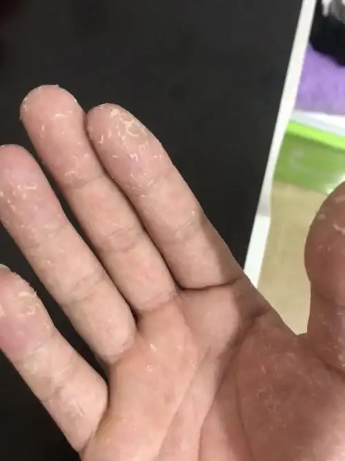 哎 这手脱皮怎么回事 时好时坏的