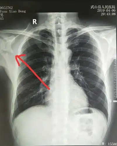 x线片示右肩胛骨粉碎性骨折,移位严重.