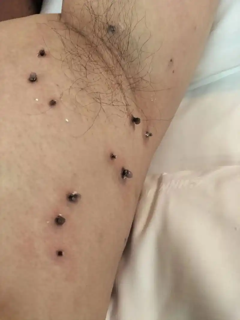 看着是不是很吓人,这就是丝状疣,不趁早去除,越来越大,越来越 - 抖音