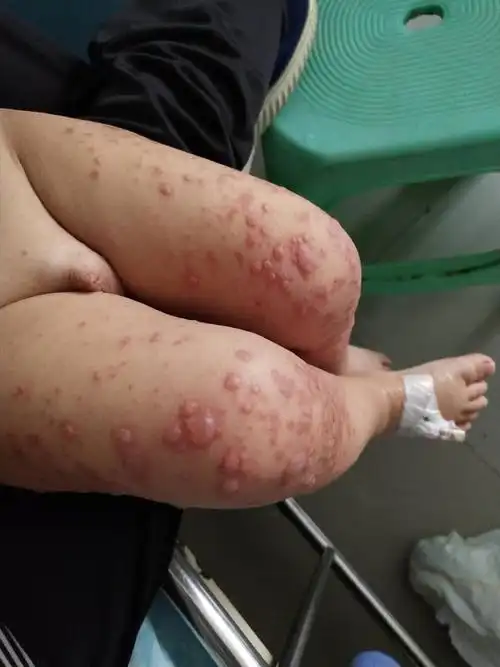 正确认识手足口病