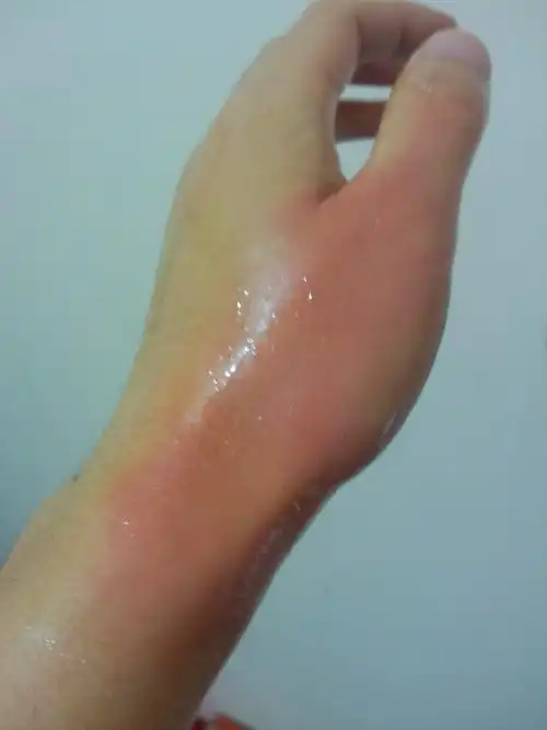 半壶水全倒手上了,手已在冷水里泡了半小时,刚去药店买了烫伤药涂上