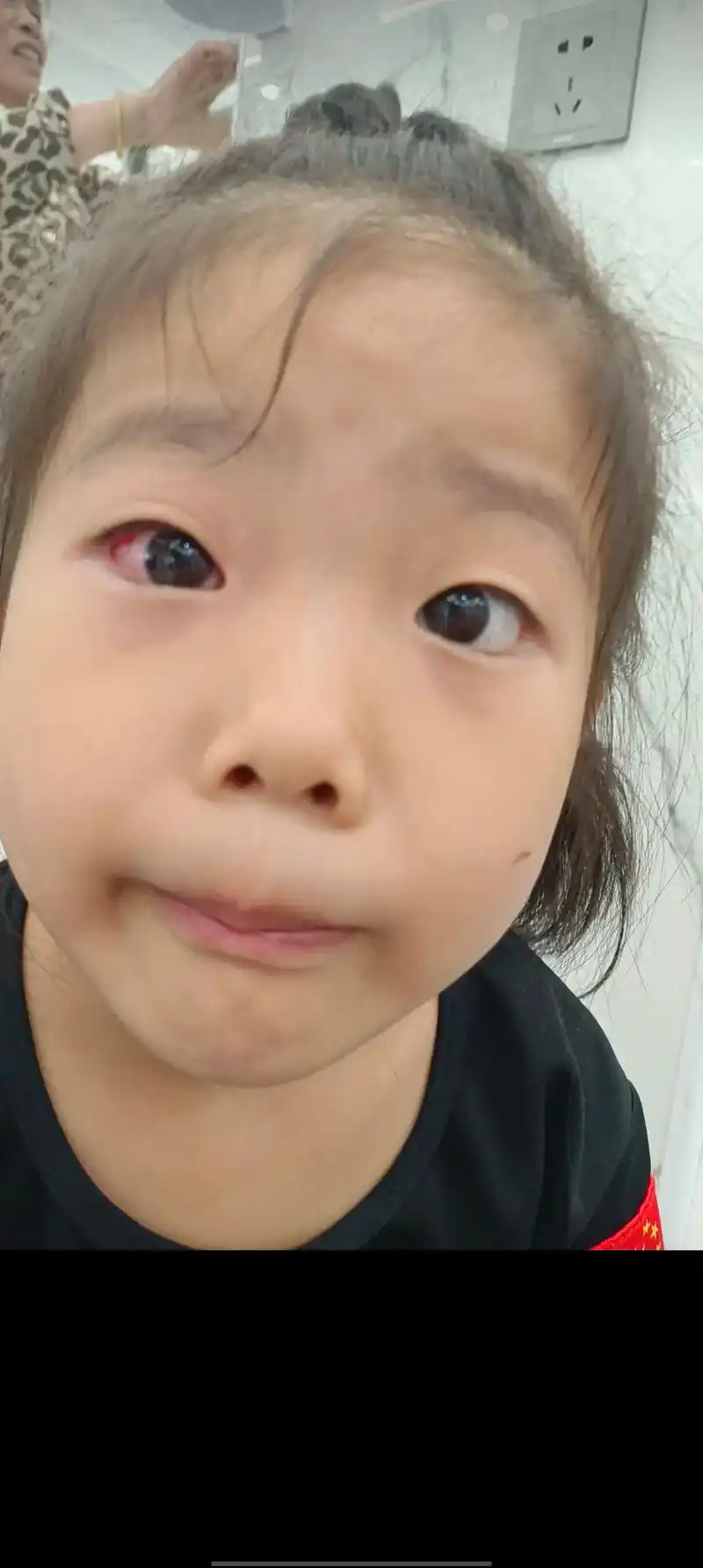 昨天女儿一个眼睛红!今天两个眼睛红,眼皮眼袋都红肿了,带她挂 - 抖音