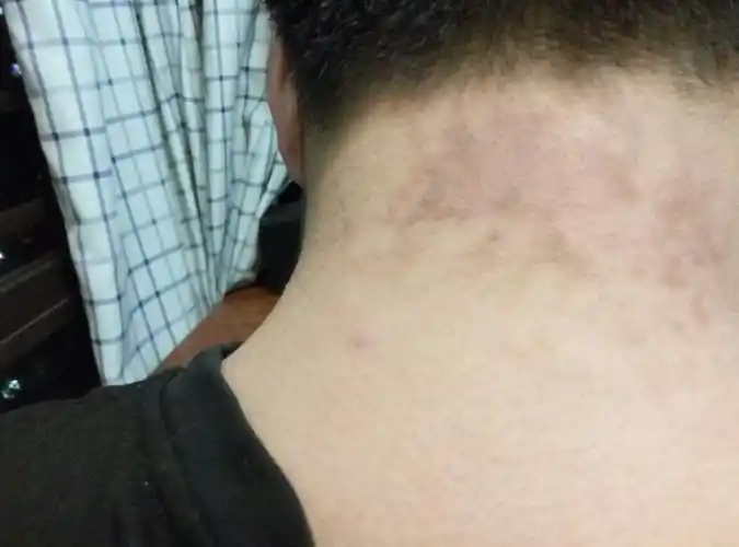 脖子后面长了黑色的像癣一样的是什么?我一开始以为是脏,但是不是啊