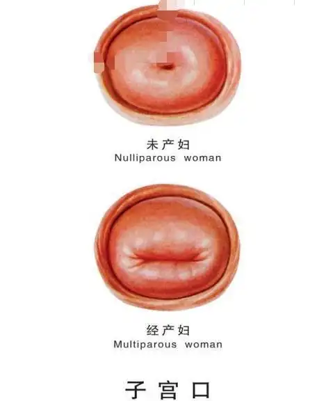 生没生过孩子,子宫的这个部位非常明显,有经验的大夫一看便知