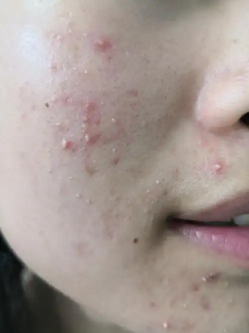 解决皮肤问题专注皮肤美容##痤疮##马拉色菌毛囊炎