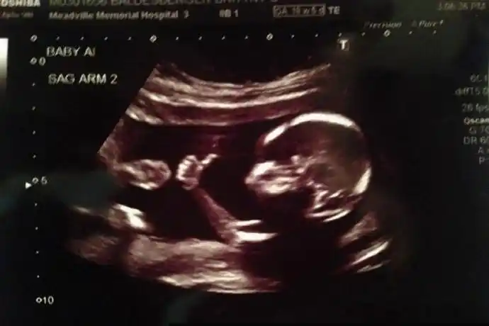 做b超检查,才18周大的小胎儿在子宫里点了个赞