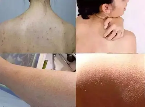 干燥粗糙鸡皮肤?