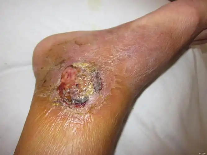 【求助】不明原因右下肢内踝部溃疡 [病例帖]