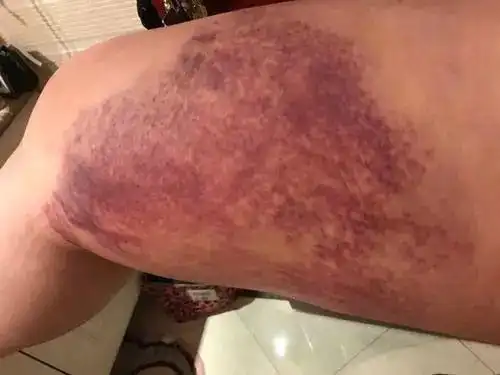 抽脂手术后的后遗症