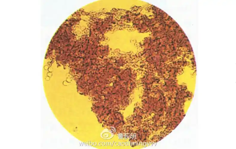 红细胞凝集图(照片来自网络)