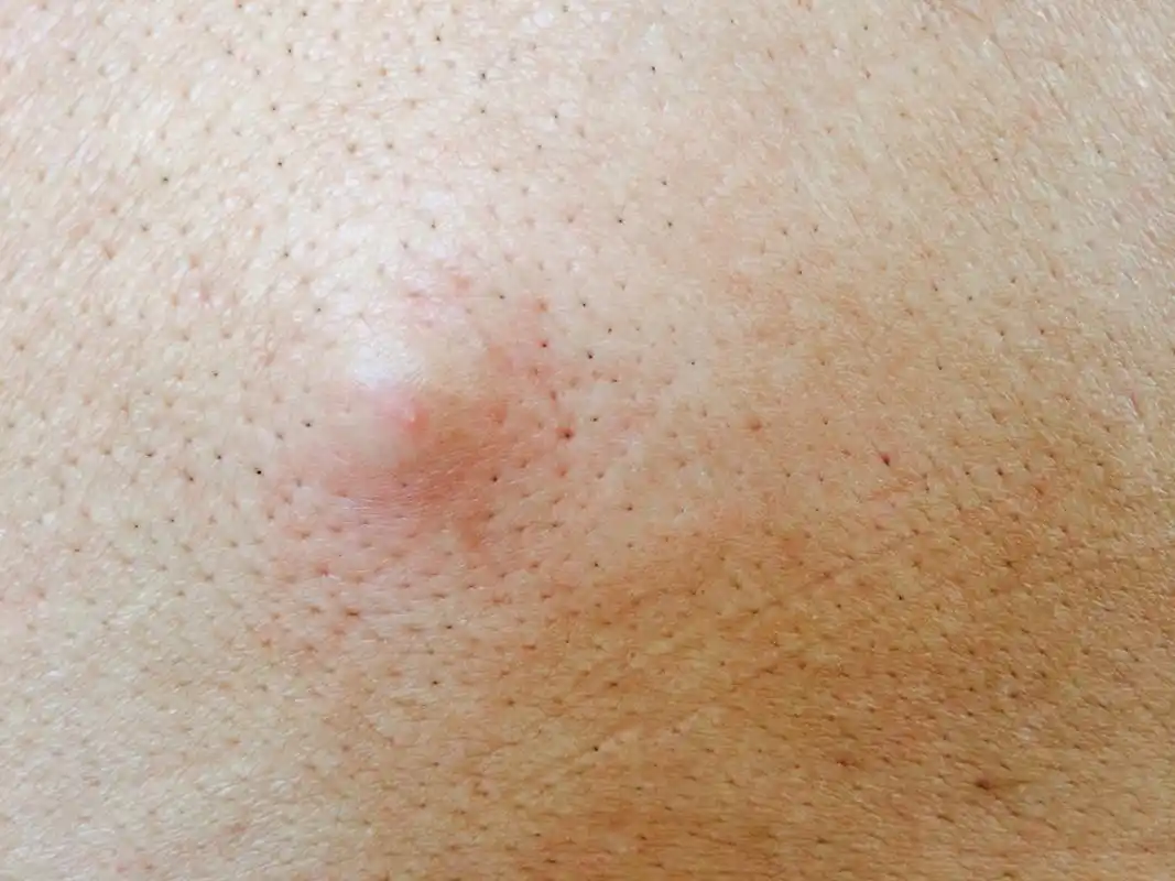 1,毛囊炎  是以毛囊受累为主的炎症性皮肤病,多由细菌感染导致,可