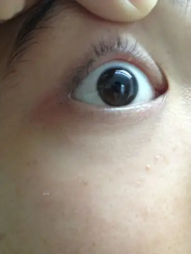 上眼睑长了粒像痘痘的东西…如何处理?