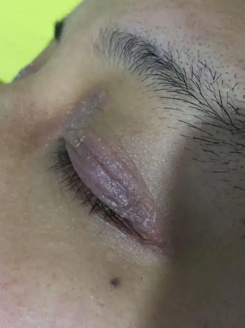 这眼皮是什么皮肤病请指点