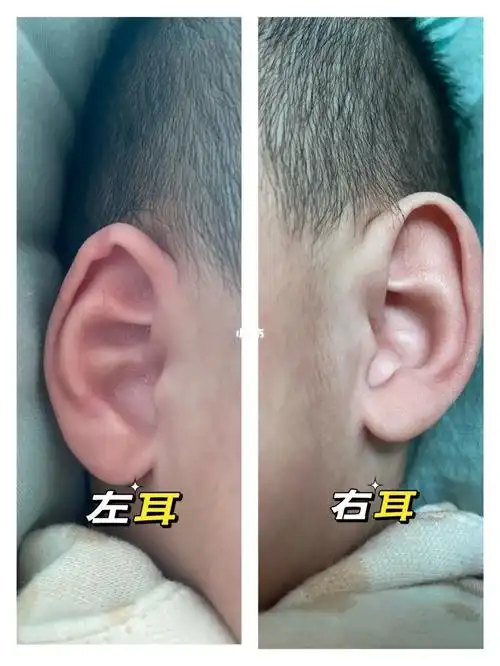 宝宝3个月了,左耳生出来就贴平,右耳是外翻的  一睡觉就卷起来,我也
