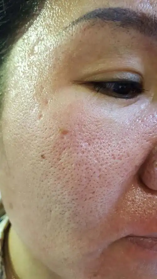 润妮秀改善毛孔粗大