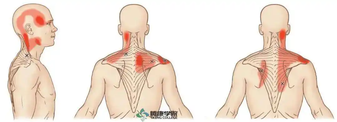 颈部僵硬的关键肌斜方肌