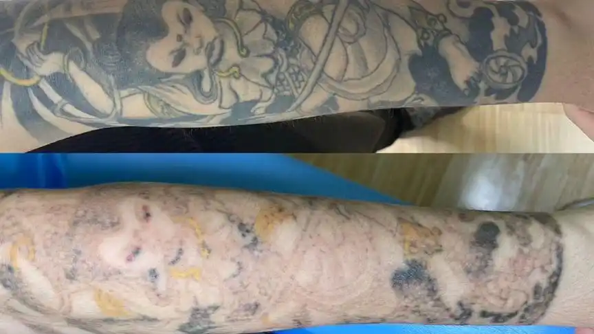 济南完美修肤洗纹身