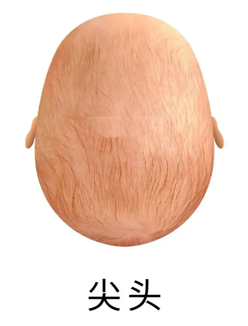 宝宝头型的秘密六尖头舟状头菱形头矫正方法 7815 前言:10年来