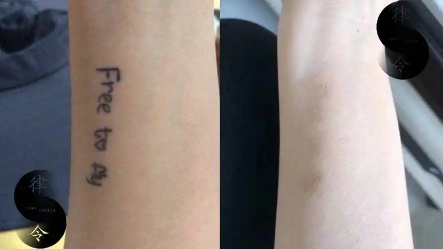 恢复速度快不留疤痕/后期恢复全程跟进指导/#洗纹身  #清洗纹身