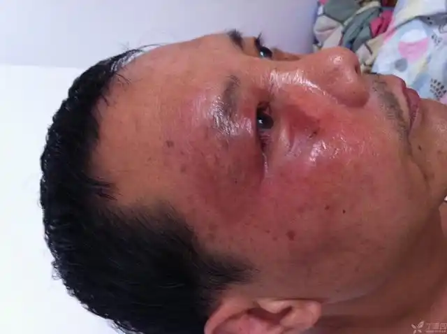 【求助】右侧脸部浮肿,有图片