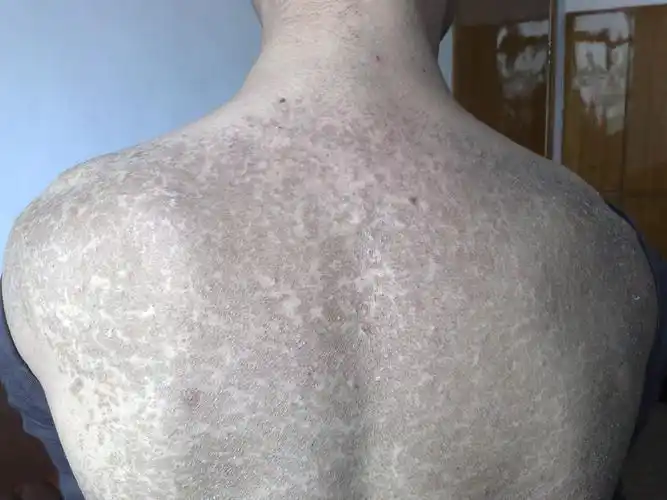 鱼鳞病患者如何日常保养_温州华医堂皮肤病专科网站