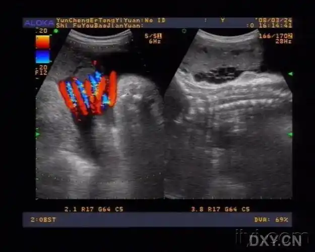 佳图共享,从脐带绕颈1周至5周. - 超声医学讨论版 - 爱爱医医学论坛
