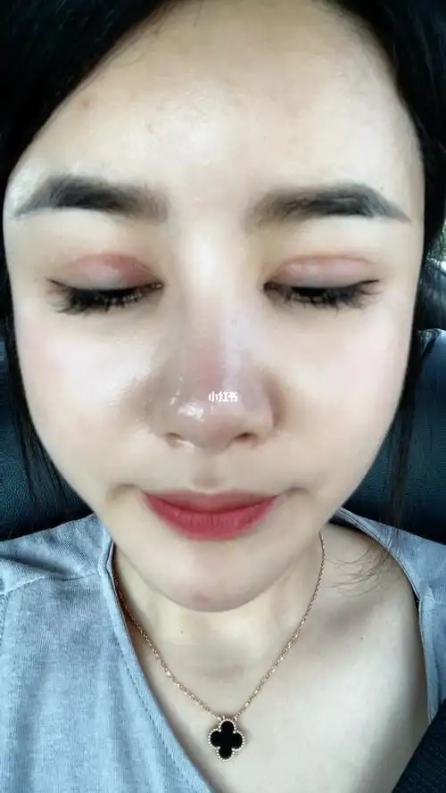 全切双眼皮27天还是很深_全切双眼皮_双眼皮手术_美妆_医美整形