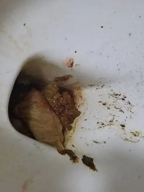 (1)消化道疾病引起大便出血:常见的主要有食管/胃底静脉曲张破裂出血