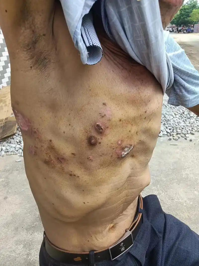 带状疱疹是急性病毒感染性皮肤病,由一种潜伏在体内神经细胞的水 - 抖