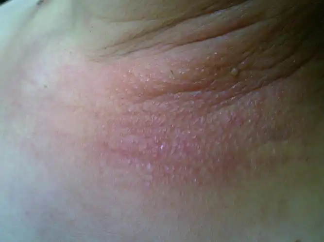 脖子上的皮肤病