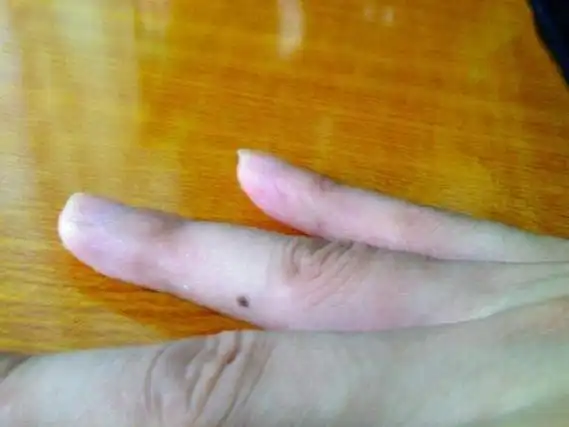 中指有痣代表贵人是自己