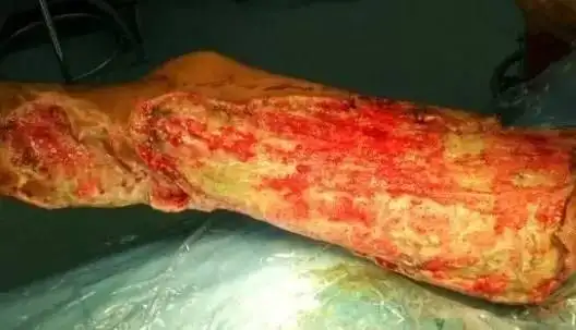 经验分享丨一例感冒致脓毒血症患者的护理