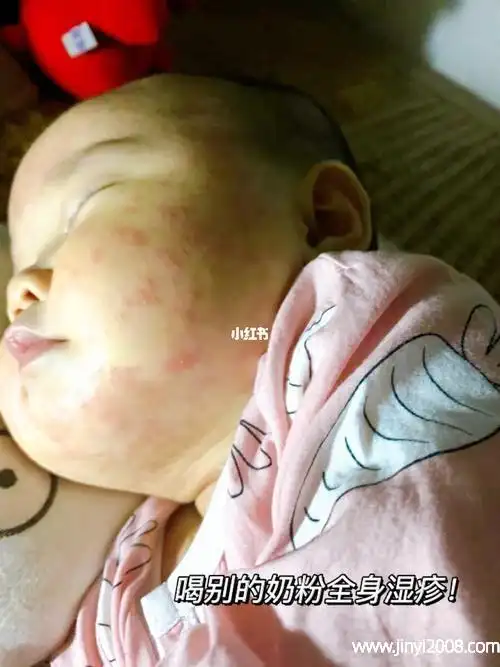 蛋白质过敏为什么痔疮患者不可以吃蚕豆