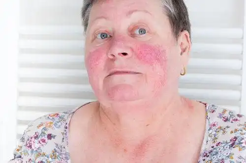 化妆品过敏怎么办