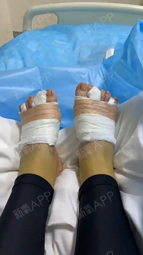 手术是局麻,所以过程中能感受到,心里会紧张,但是打了麻药基本是不疼