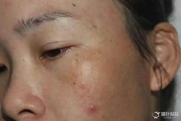 的,我管不着了虽然长的不漂亮但我真的不能忍受这么恶心的痘痘在脸上