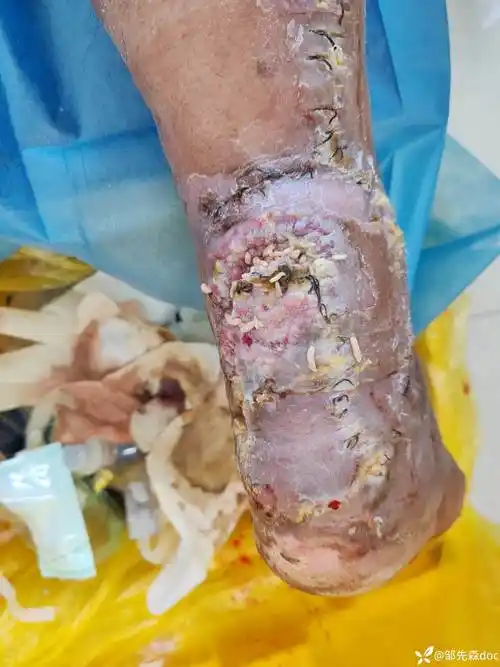 自诉20多天前外院小腿皮瓣修复术后出院回家4天前发现小腿长蛆今来我