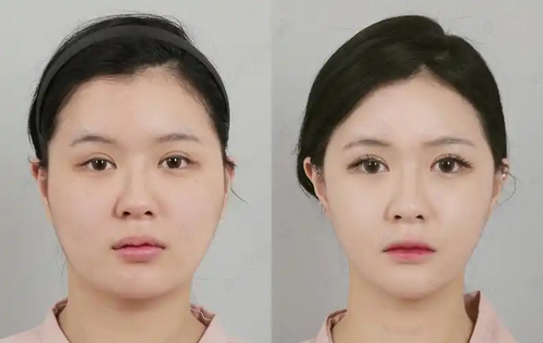 韩国id脂肪填充对比案例