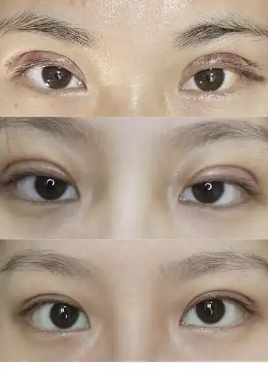 全切平行双眼皮案例