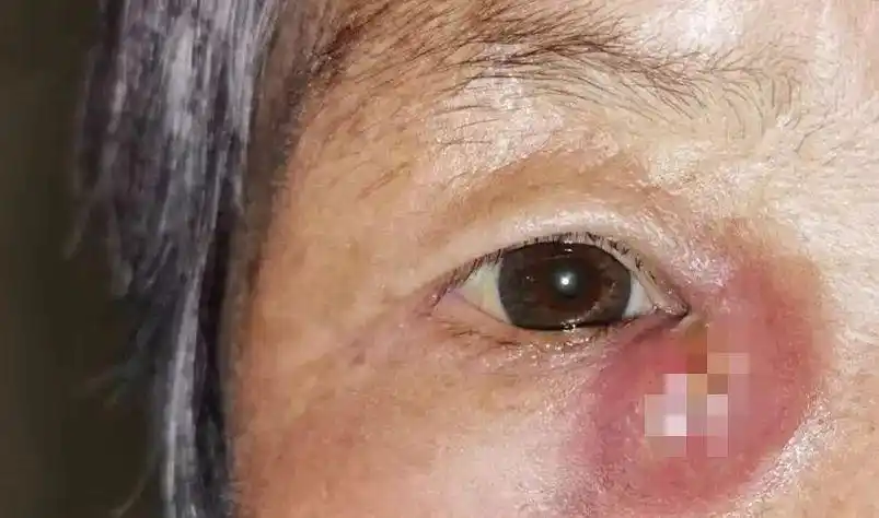 直到今年 2 月,徐大姨右眼角又出现一个直径约 2 cm 的小包块,以往