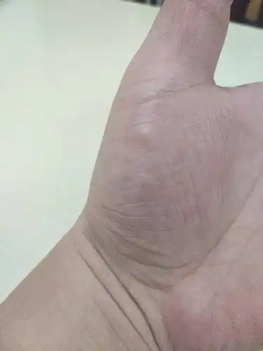 手掌金星丘位置鼓了个米粒大小的包,不疼不痒的,是什么原因