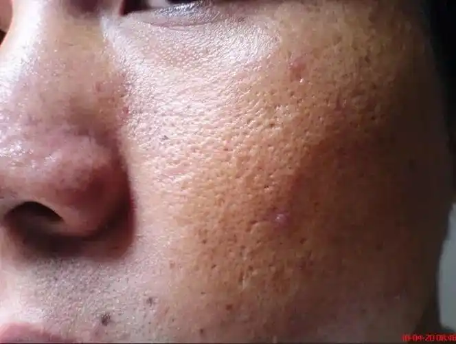 炎热夏季 皮肤问题多发,为什么一到夏天 皮肤特别油?