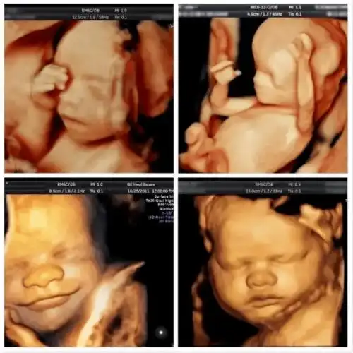 忙碌!胎儿四维彩超照片"三三两两"-第2张图片-星空博客