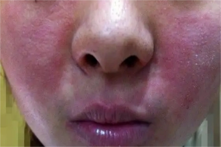 左氧氟沙星过敏图片_有来医生