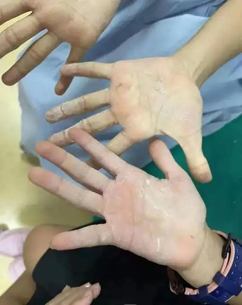 遭到他人恶作剧,南宁两个小女孩手掌被502胶水粘住分不开!_处理